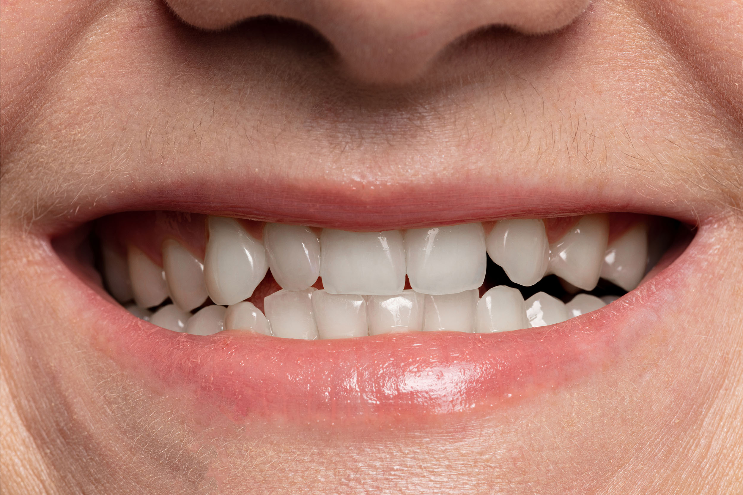 blanchiment des dents salon de provence
